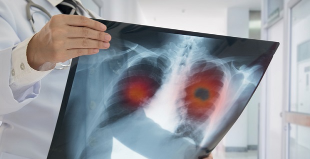 Cancer du poumon aux rayons x