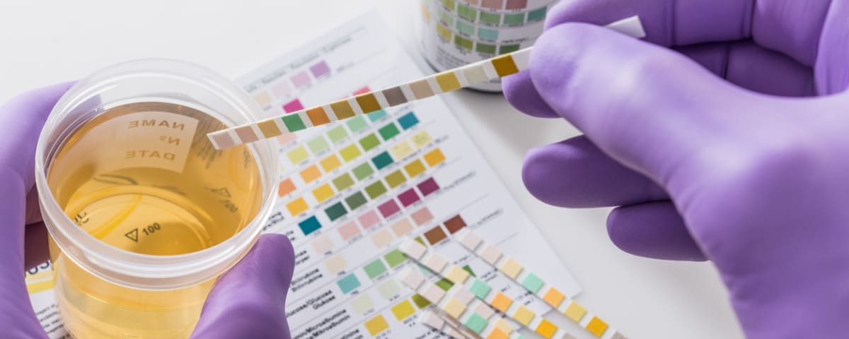 Les tests urinaires pour dépister la cystite disponibles en pharmacie