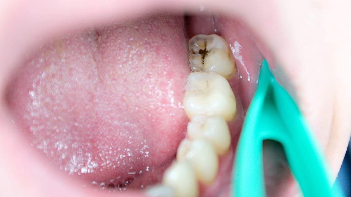 Les cas de carie non soign&eacute;e chez les enfants pr&eacute;occupent la HAS