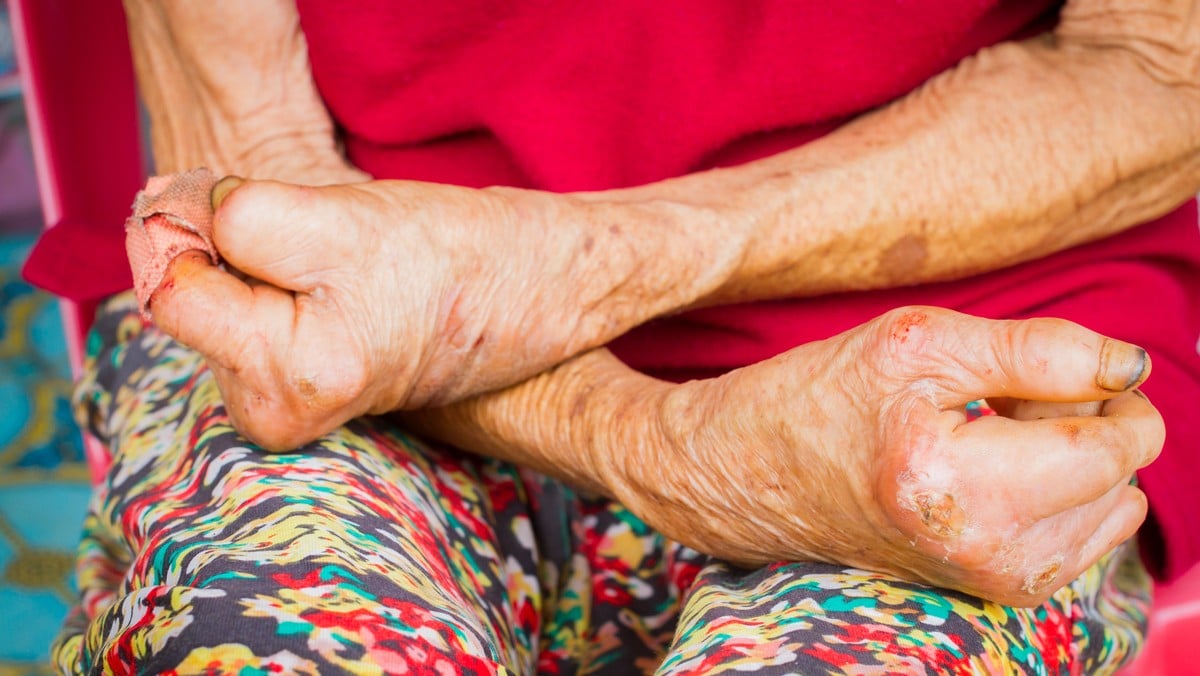 Des cas de l&egrave;pre ont &eacute;t&eacute; confirm&eacute;s en Roumanie et en Croatie