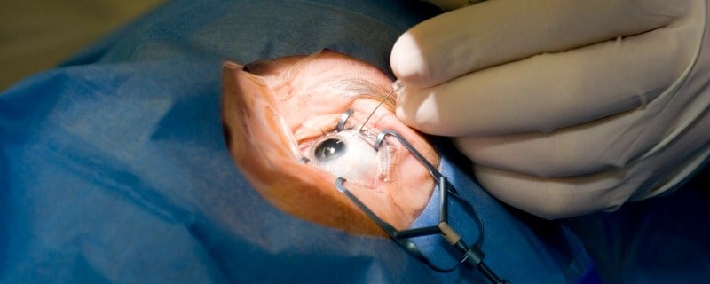 prise en charge opération de la cataracte par la mutuelle